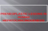Preneoplastic  lesions in human hepatocarcinogenesis