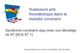 Syndrome  coronaire aigu avec sus décalage de ST (SCA ST  +)