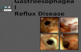Gastroesophageal  Reflux Disease