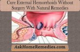 Cure External Hemorrhoids Without Surgery With Natural Remedies.