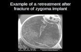 Retreatment of a fractured zygoma implant
