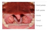 Tonsil Stones Cure Removing Tonsil Stones