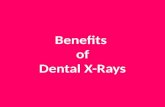 Benefits of Dental X-Rays