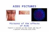AIDS PICTURES Pictures of the effects of Aids Kaposi's sarcoma on the trunk and leg of a person affected with AIDS.