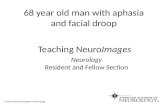 68 year old man with aphasia and facial droop © 2014 American Academy of Neurology Teaching NeuroImages Neurology Resident and Fellow Section.