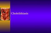 Cholelithiasis. A Cause For Pain Background  Presence of gallstones in the gallbladder.  Spectrum ranges from asymptomatic, colic, cholangitis, choledocholithiasis,