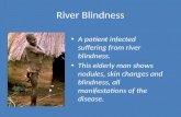 River Blindness A patient infected suffering from river blindness. This elderly man shows nodules, skin changes and blindness, all manifestations of the.