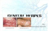 GENITAL HERPES.pptx