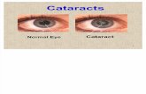 Cataract Shivappa