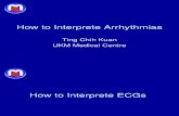How to Intepret Arrythmias