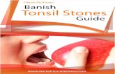 Banish Tonsil Stones PDF, eBook by Diane Puttman
