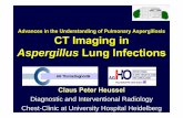 CT Imaging in Aspergillus Lung Infections