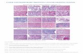 A NEW CONTEMPORARY PROSTATE CANCER GRADING SYSTEM