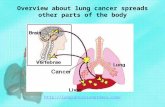 Overview about lung cancer spreads other parts of the body