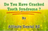 Do You Have Cracked Tooth Syndrome?