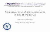 An unusul case of adenocarcinoma in situ of the cervix