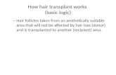 Limitations of Hair Transplant