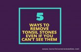 5 Ways to Remove Tonsil stones without touching
