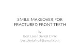 Smile makeover with Dental Implant for Fractured Front teeth in INDIA