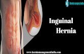 Inguinal Hernia Surgery In Chennai | Hernia Treatment Centre In India