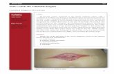 Skin Lesion On Umbilical Region