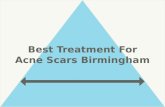 Best Treatment for Acne Scars Birmingham