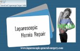 Laparoscopic Hernia Repair In Bangalore | Best Laparoscopic Surgeon In India