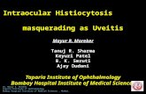 Intraocular Histiocytosis Masquerading As Uveitis