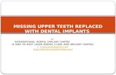Missing upper teeth replaced with dental implants
