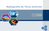 Radiografia de Torax Anormal