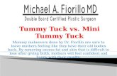 Tummy tuck vs