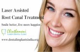 Laser Root Canal Treatment In Chennai | Tooth Decay Treatment In Tamil Nadu