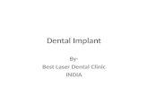 Painless dental implants in india