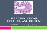 Serrated lesions of colon and rectum