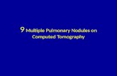 9 multiple pulmonary nodules on computed tomography