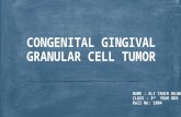 Congenital gingival granular cell tumor