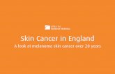 Skin Cancer in England: A look at melanoma skin cancer over 20 years