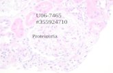 U06-7465 #355924710 Proteinuria. 52 year old female followed for dextrocardia and Tetralogy of Fallot complicated by pulmonary hypertension and right.