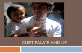CLEFT PALATE AND LIP. Description Cleft lip is when there is a failure of the lip growth plates to fuse in utero. Cleft palate is the failure of the palate.