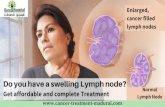 Lymph Node Cancer Treatment In Madurai | Best Cancer Centre In Tamil Nadu