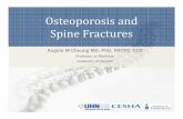 Osteoporosis and Spine Fractures - · PDF fileReduced survival after vertebral and hip fracture 0 20 40 60 80 100 Vertebral 0 20 40 60 80 100 Hip Years after fracture 0 20 40 60 80