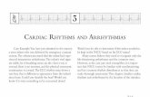 cardiac rhythms aNd arrhythmias - Academy of … rhythms can be classified as five types: Sinus: Sinus rhythms originate in the SA node. They may be normal, fast, slow, or irregular.