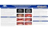 “Pott’s Puffy Tumor”: Medical/Surgical Management in the ... · PDF fileStudy Design: Surgical case report with digital ... Pott’s puffy tumor is a rare disease. ... In the