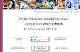 Partial fractures around the knee: bone bruise and fractures · Partial fractures around the knee: bone bruise and fractures Advanced knee course, Val d’Isère, 01-2016 Centre Hospitalier