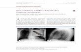 The Leadless Cardiac Pacemaker - JACC: Clinical ...electrophysiology.onlinejacc.org/content/jcep/1/4/335...IMAGES IN ELECTROPHYSIOLOGY The Leadless Cardiac Pacemaker Conductive Communication