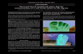 Reversed dorsal metatarsal artery flap for reconstruction ... · Reversed dorsal metatarsal artery flap for ... The dorsalis pedis artery, which is an extension of the anterior tibial