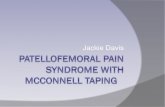 Patello-Femoral Pain Syndrome with McConnell …behrensb/documents/Patello-FemoralPainSyndrome...What is petellofemoral Pain syndrome? “Patellofemoral Syndrome can be defined as