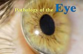 Pathology of the€¢ Optic Neuritis –Many causes, but demyelinating (Multiple Sclerosis) causes are most important • Papilledema – swelling due to increased intracranial pressure
