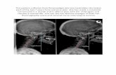 This patient suffered from fibromyalgia and was … scans and cervical curve returning to normal. Title Microsoft Word - fibromyalgia-patient.docx Author sam1 Created Date 10/7/2013