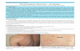 Dermatophyte Infections An Update - WordPress.com · 06.04.2016 · Common clinical types of tinea capitis ... spaces are seen within the air shaft. ... refers to infection of the
